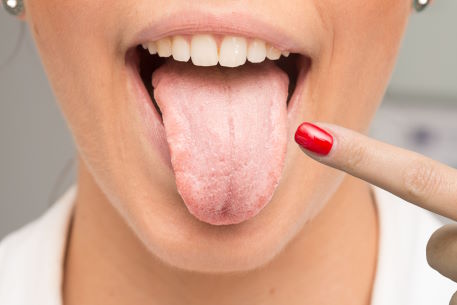 Candidiasis
